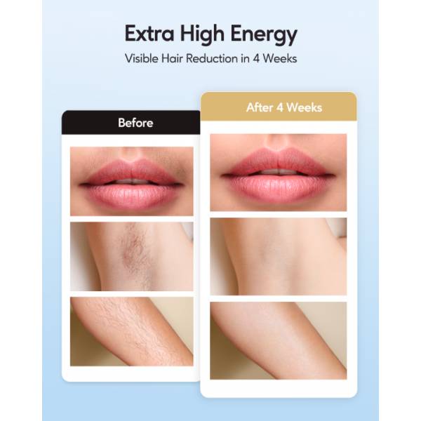 INNZA Laser Hair Removal With Ice Cooling Care Function For Women Permanent,999,999 Flashes Painless IPL Hair Remover, Hair Removal Device For Armpits Legs Arms Bikini Line